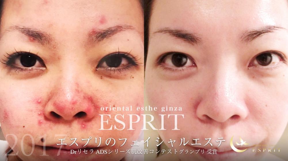 ノーファンデーションで輝く美肌!ドクターリセラ ADSシリーズ朝と夜のお手入れ方法!