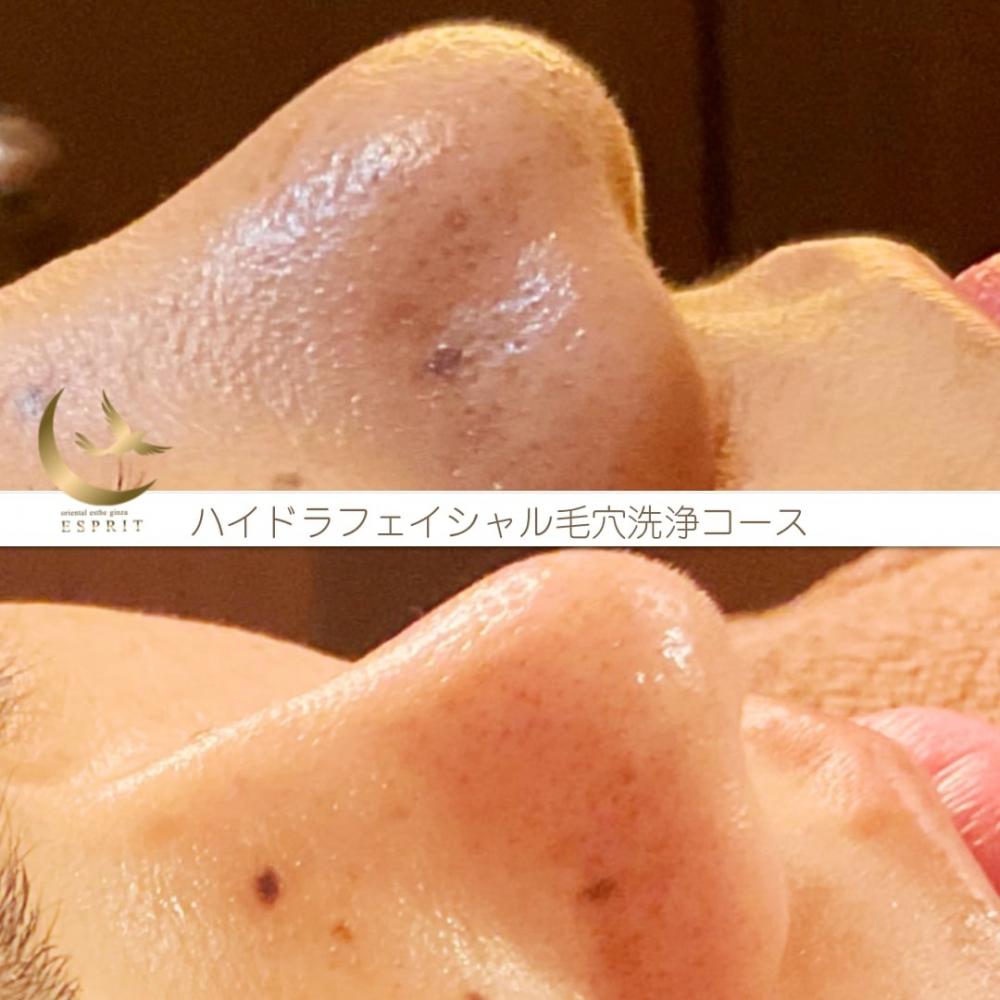 しっかりと詰まっていた皮脂汚れが取れてスッキリ!!