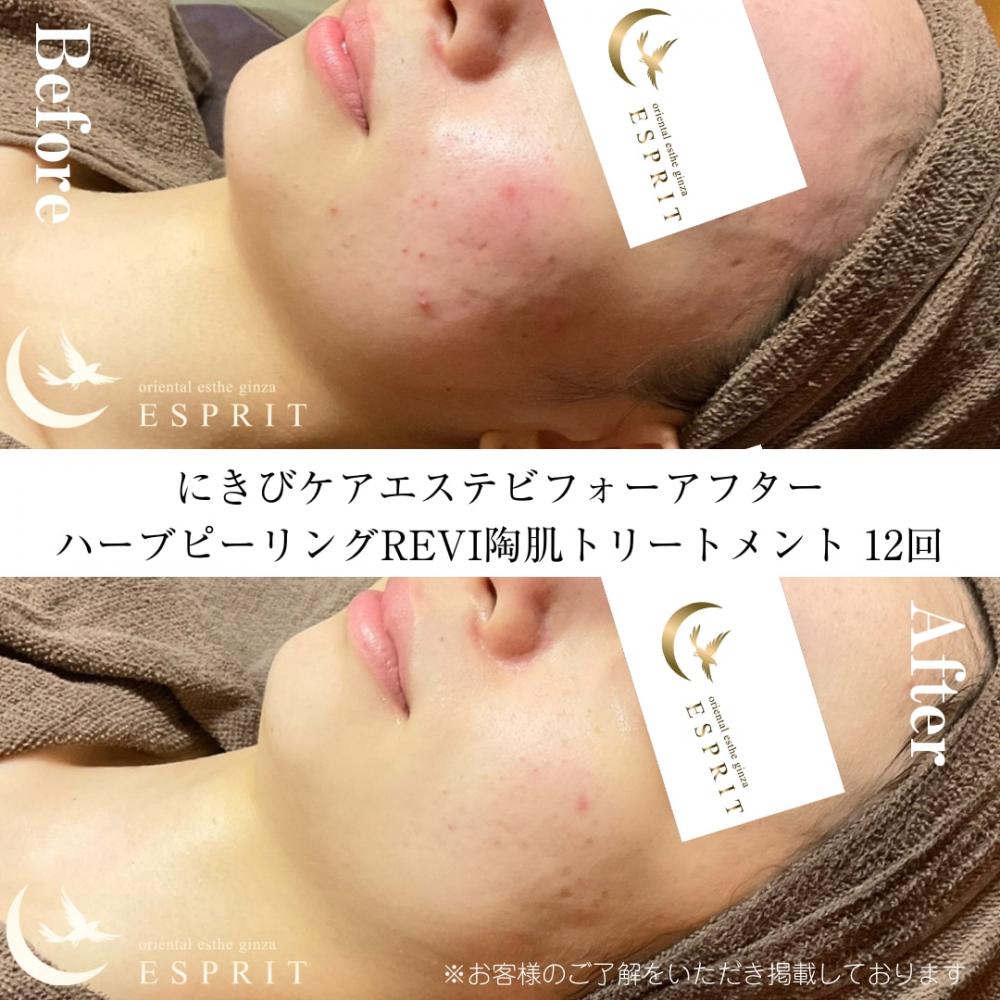 【エスプリ式ハーブピーリング】毛穴・ニキビ跡・くすみに!銀座・新宿の人気肌改善エステ