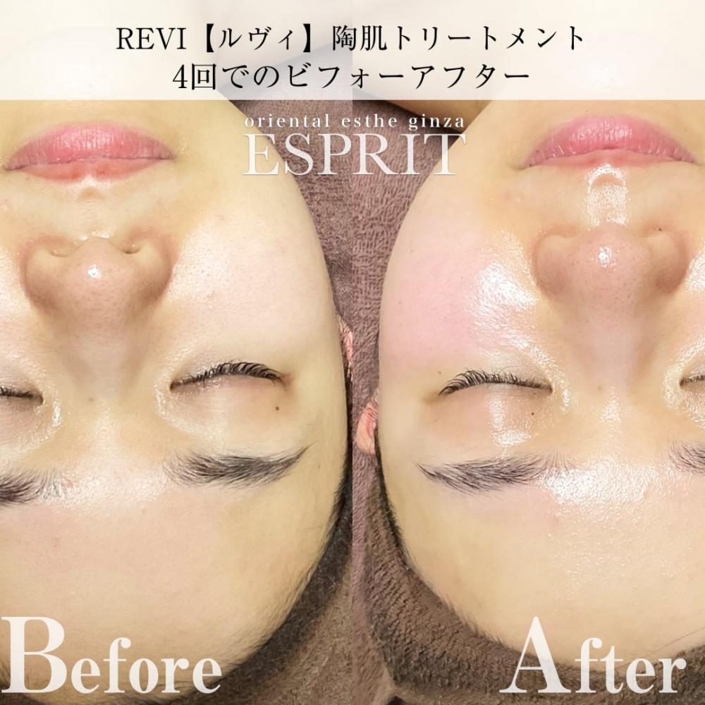 MEGUMIさんもオススメのREVI【ルヴィ】陶肌トリートメント!ビフォーアフターをご紹介