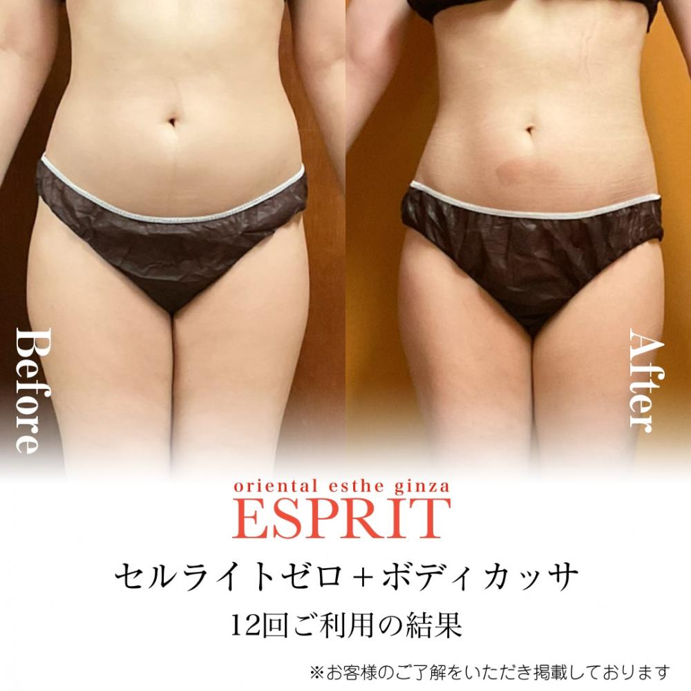 【Before→After公開】セルライトゼロ+ボディカッサ