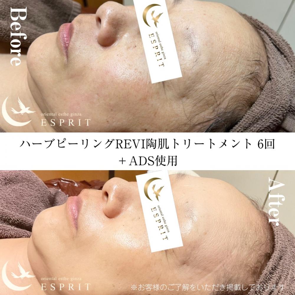 ハーブピーリングREVI陶肌トリートメント 6回+ADS使用(シミやしわ)