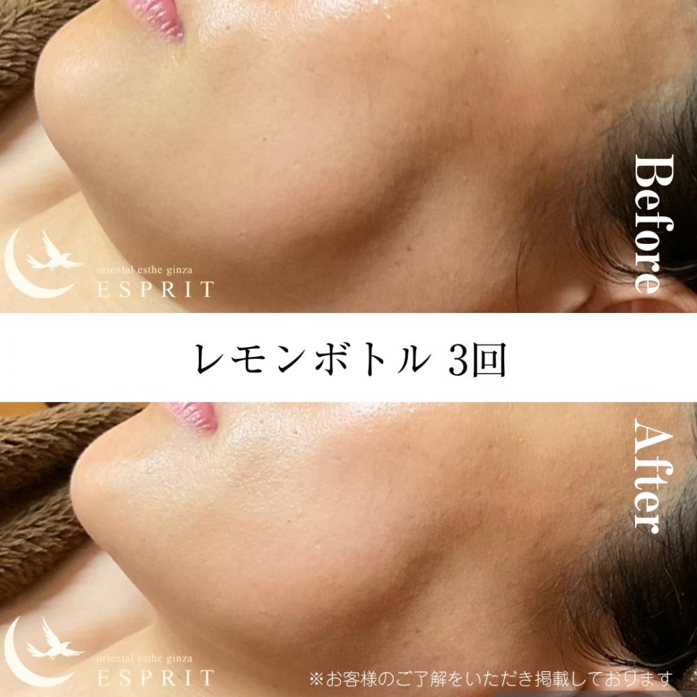 レモンボトル 3回（フェイスライン）