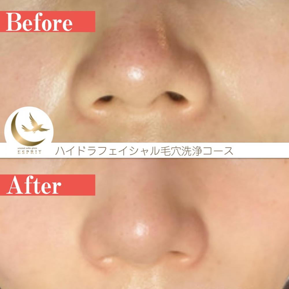 気になる毛穴ケア！エステサロンでのビフォーアフターをご紹介します！ エスプリニュース（詳細）｜銀座、新宿のエステサロン 痩身＆肌改善