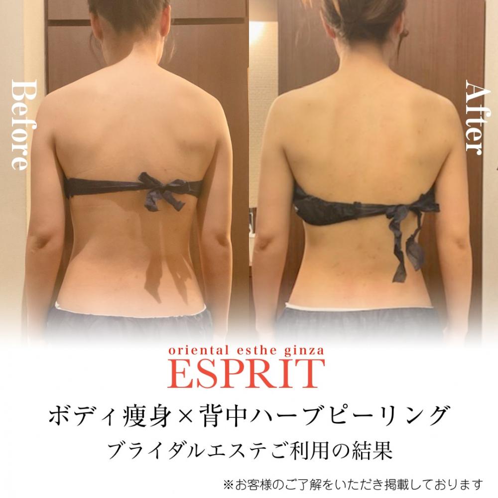 【Before→After】ブライダルエステで背中もスッキリ