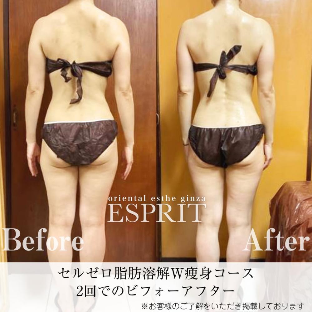 2回だから差がつく体験お試しコース!セルゼロ脂肪溶解W痩身コースをご紹介します!