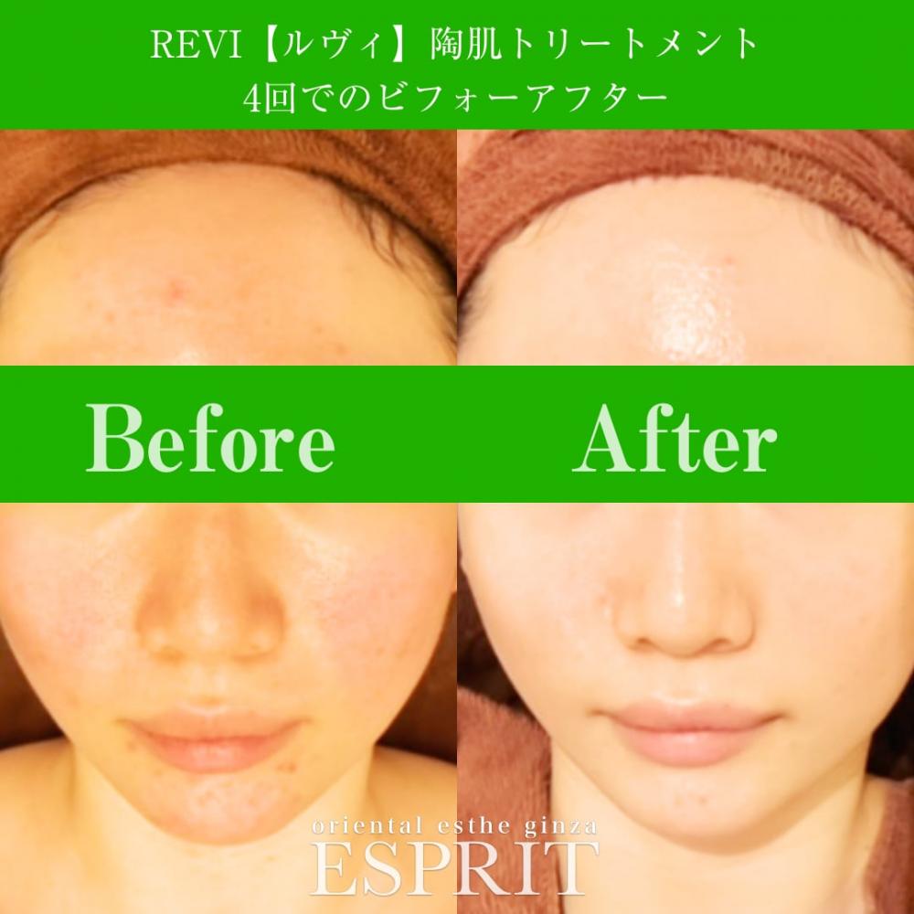 REVI陶肌トリートメントで大人ニキビをケア?ビフォーアフターで見る凄い実力をご紹介
