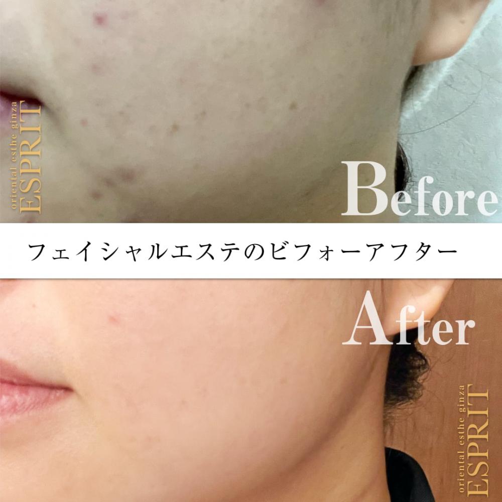 REVI陶肌トリートメントで大人ニキビをケア?ビフォーアフターで見る凄い実力をご紹介