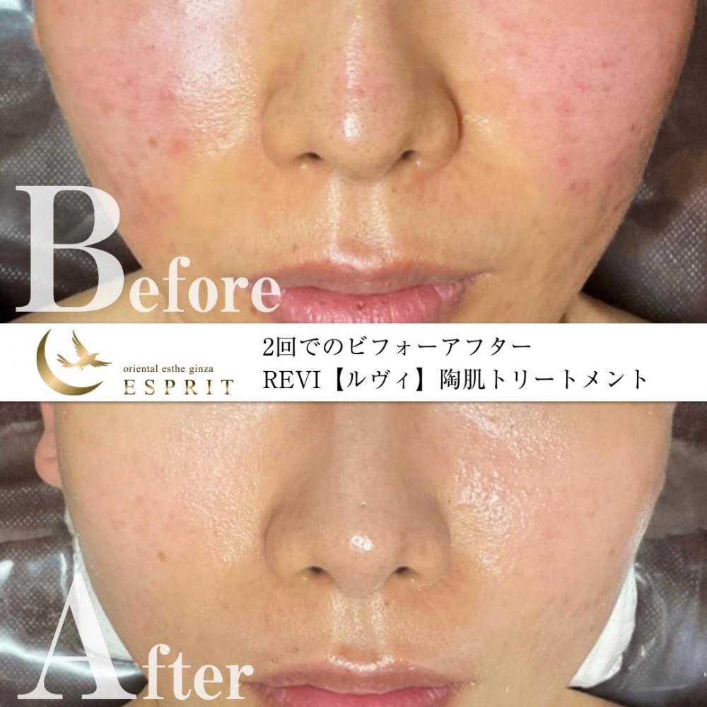 年末年始に無理したお肌へ。ハーブピーリングREVI陶肌トリートメントで肌リセット