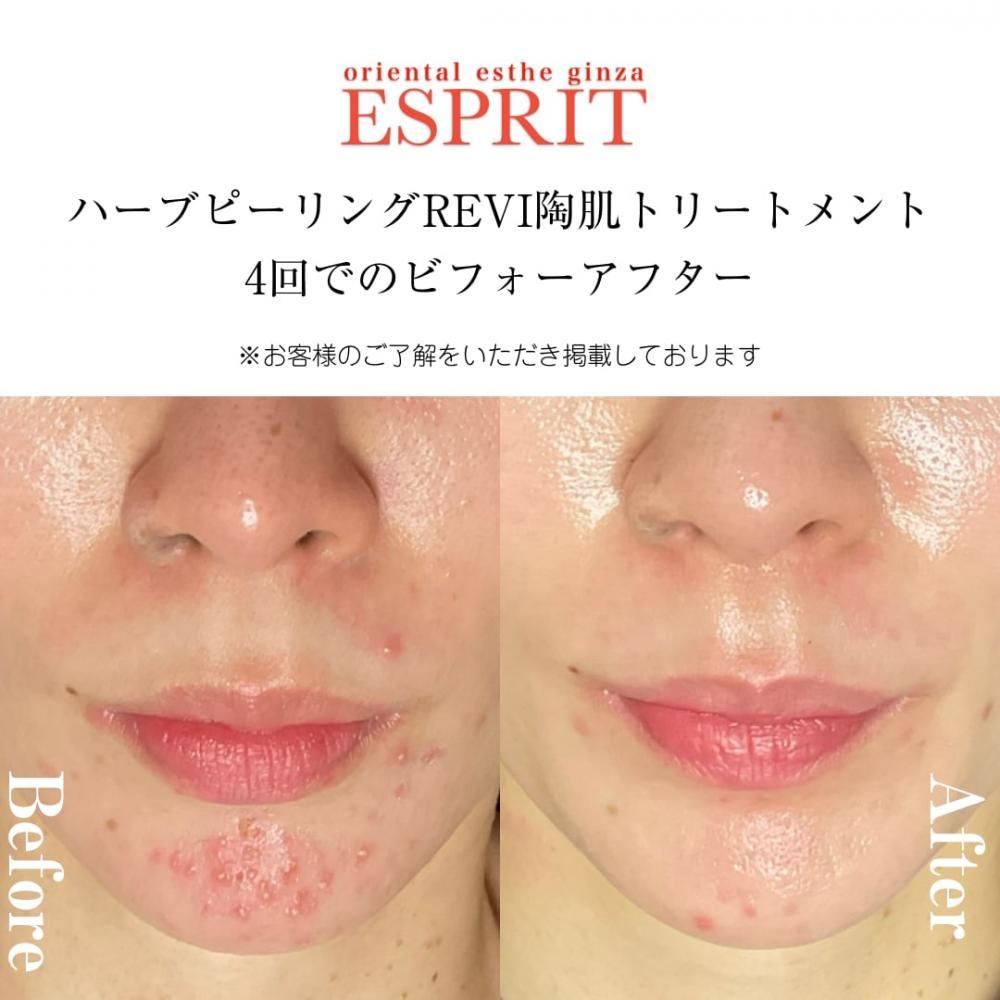 年末年始に無理したお肌へ。ハーブピーリングREVI陶肌トリートメントで肌リセット