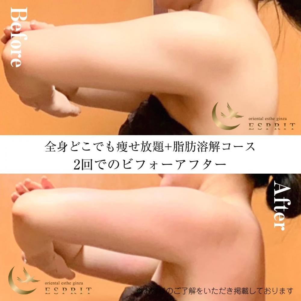 二の腕やせは自分ではどうしようもなかったのですが、エスプリさんのおかげでスッキリです