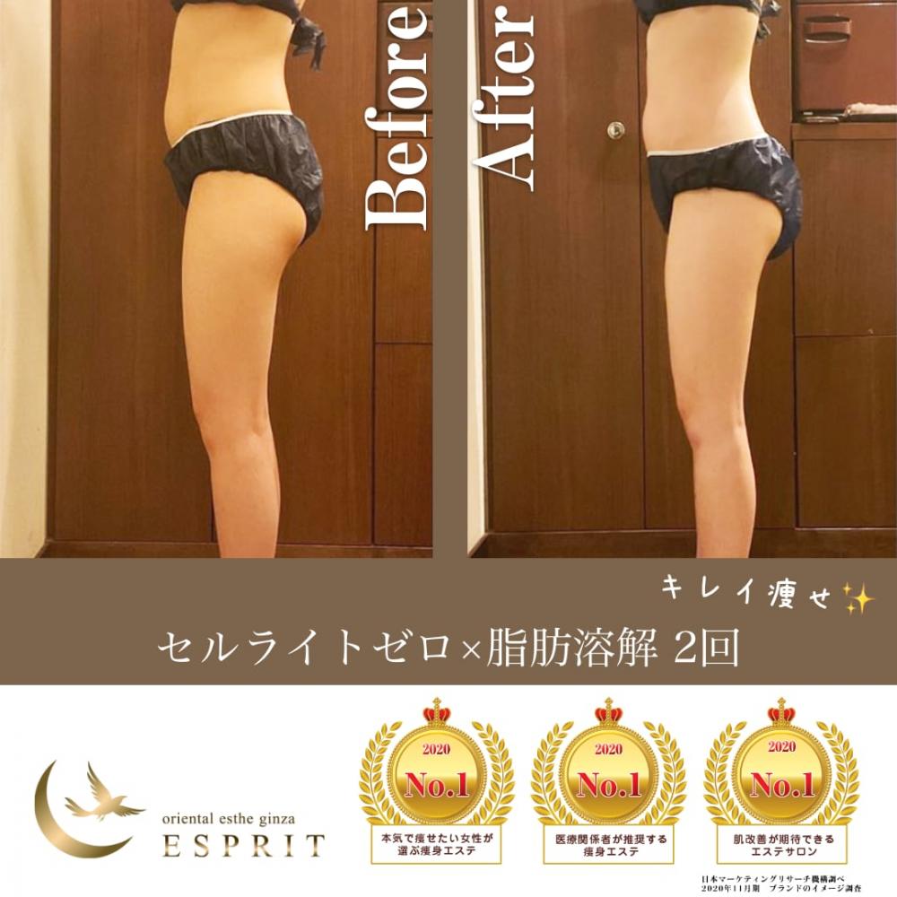 今一番HOTなメディカル痩身!セルゼロ脂肪溶解W痩身コースをご紹介します!