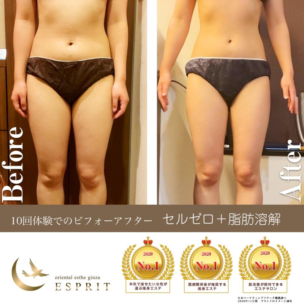 今一番HOTなメディカル痩身!セルゼロ脂肪溶解W痩身コースをご紹介します!