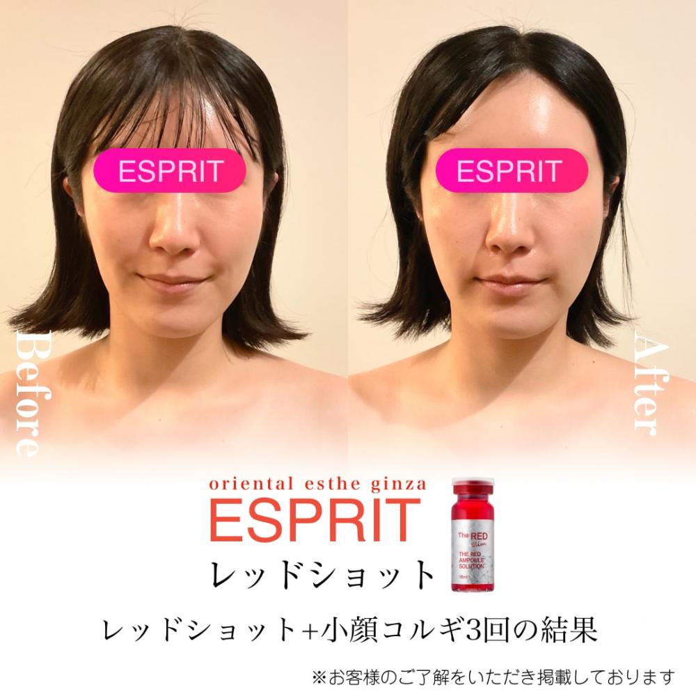 【痩身・小顔エステの事例】2026年2月ビフォーアフター｜銀座・新宿エスプリ