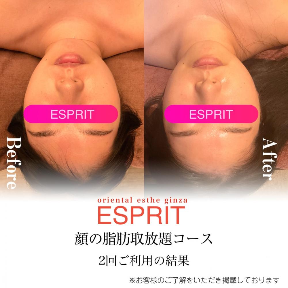 【痩身・小顔エステの事例】2026年2月ビフォーアフター｜銀座・新宿エスプリ