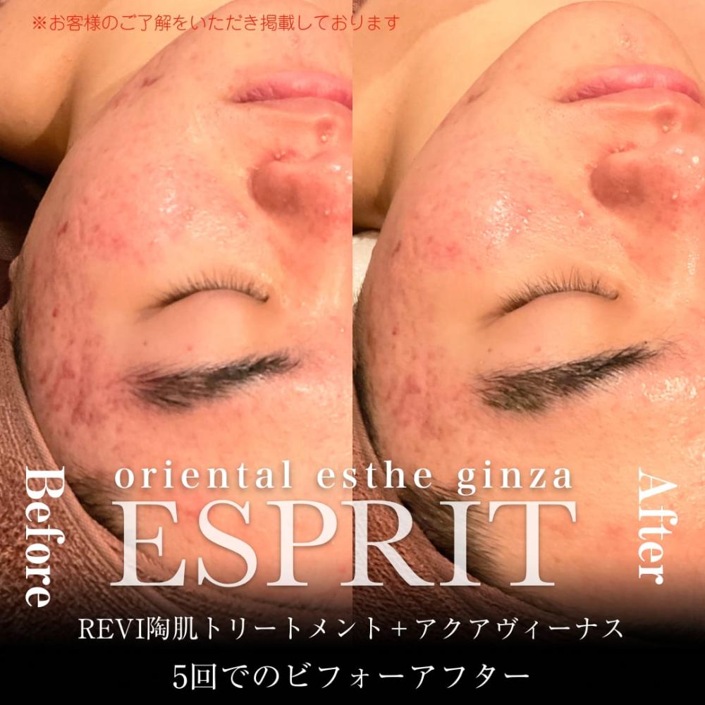 2024年2月の痩身&肌改善(肌管理)エステコースのビフォーアフターをご紹介!