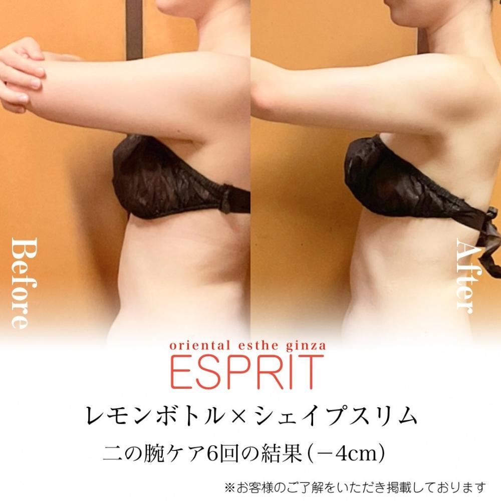 【二の腕】部分痩せケア事例紹介【Before→After】