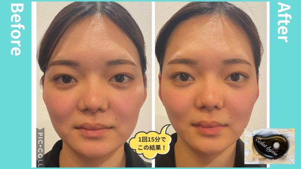 驚くほど小顔に~エクラビジューカッサ~