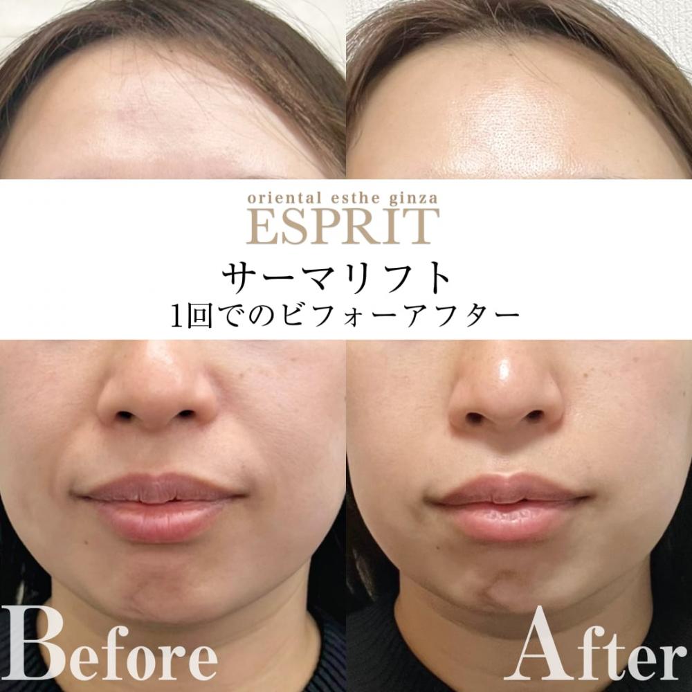 小顔×リフトアップ!たるみと脂肪にWでアプローチする最新フェイシャルリフトアップ術