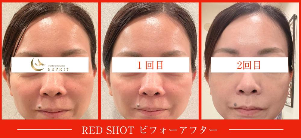 大人の小顔設計【レッドショット】の効果とは?レモンボトルとの違いとフェイスラインケア解説