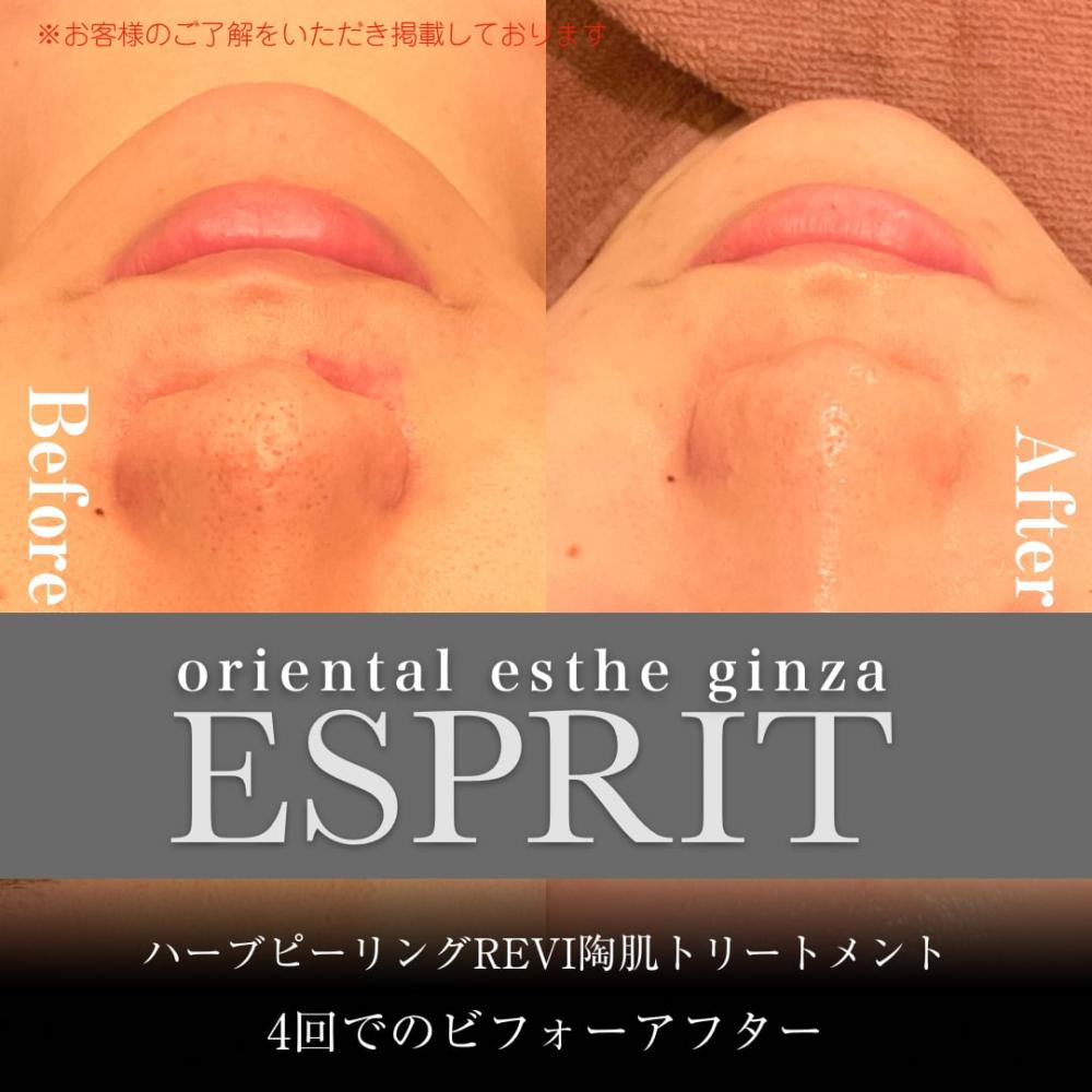 2024年3月の痩身&肌改善(肌管理)エステコースのビフォーアフターをご紹介!