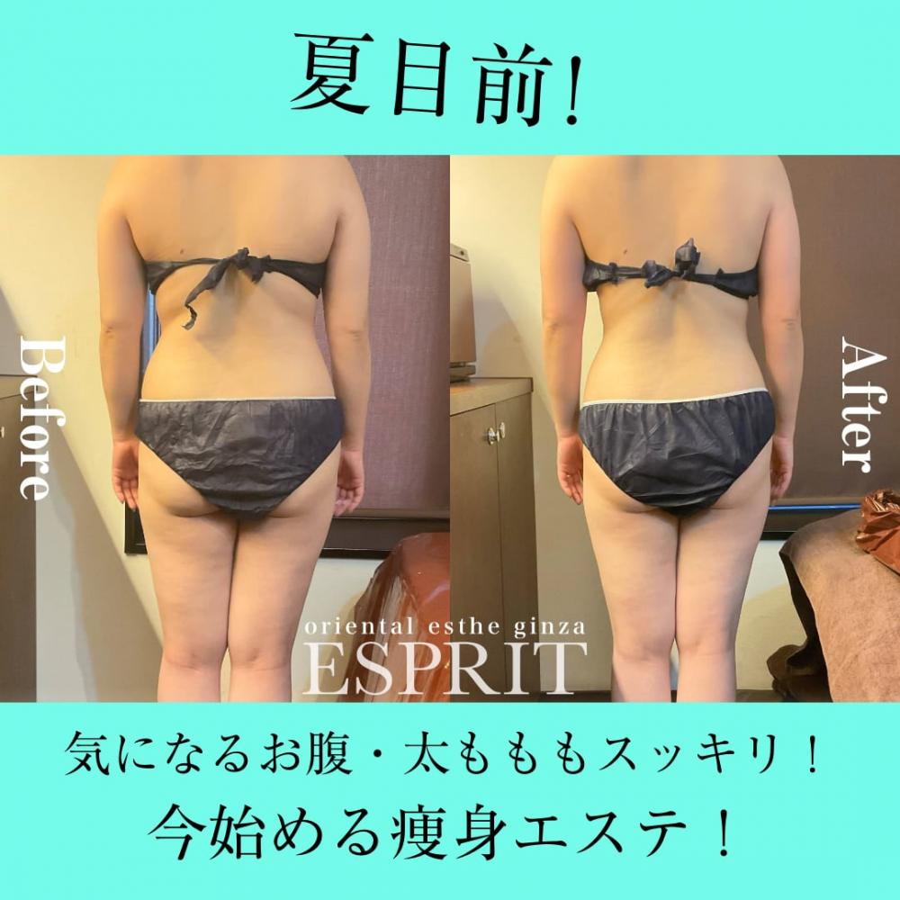 夏目前！気になるお腹・太もももスッキリ！今始める痩身エステ！