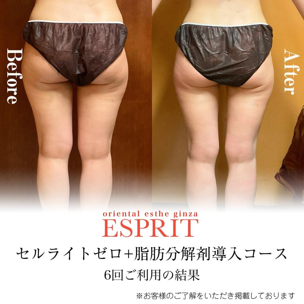 夏目前!気になるお腹・太もももスッキリ!今始める痩身エステ!