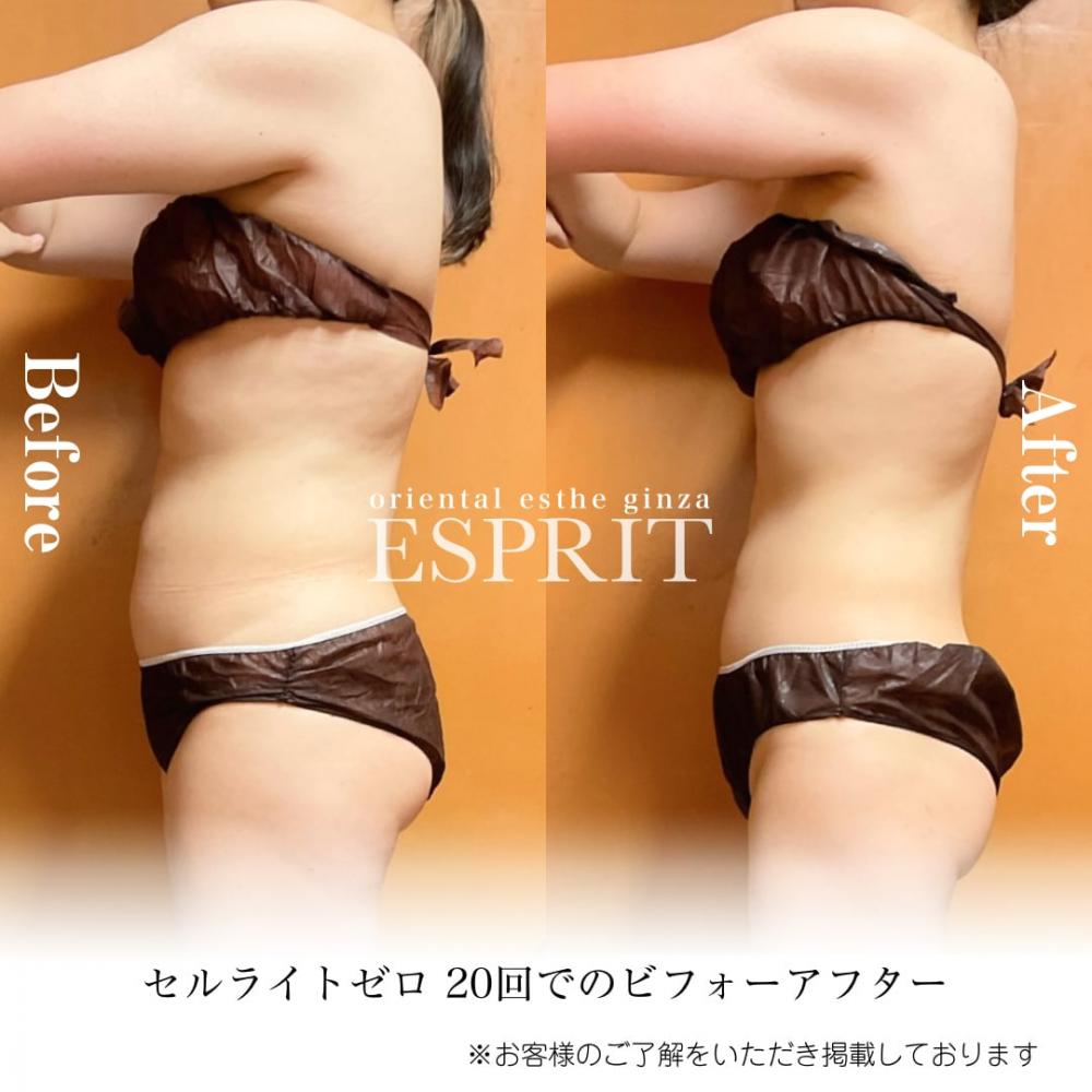 2024年4月痩身&肌改善(肌管理)エステコースのビフォーアフターをご紹介!
