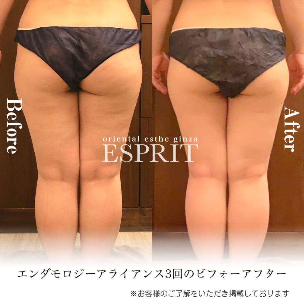 2024年4月痩身&肌改善(肌管理)エステコースのビフォーアフターをご紹介!