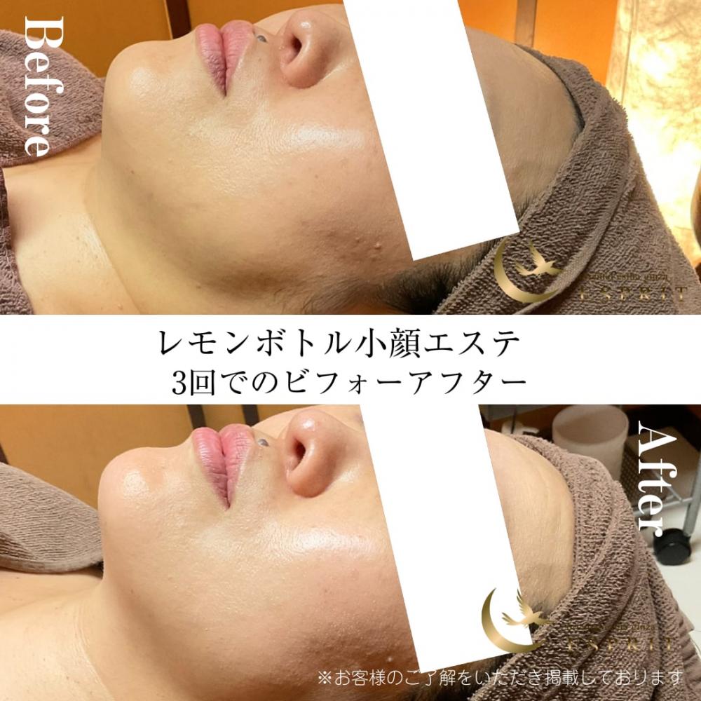 「部分痩せ&小顔ケアに大人気!脂肪溶解“レモンボトル”をQ&Aで徹底解説」