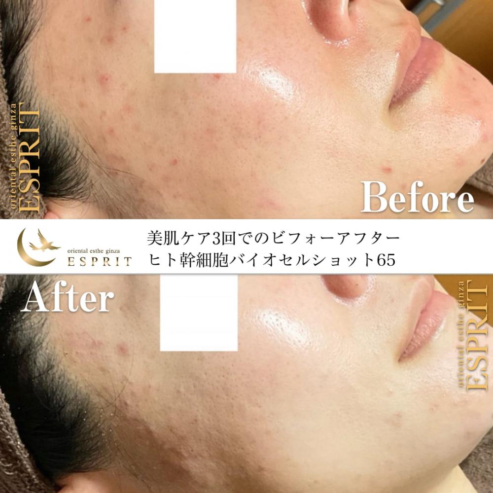 ヒト幹細胞はやっぱりエイジングケアNo.1です!