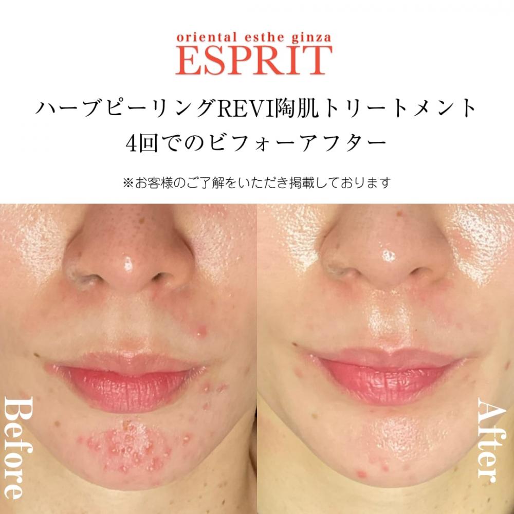 REVI陶肌トリートメントで“自分史上最高の素肌”へ!エスプリのビフォーアフター&Q&A完全ガイド