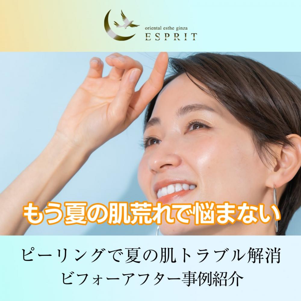 もう夏の肌荒れで悩まない！ピーリングで夏の肌トラブル解消！事例紹介
