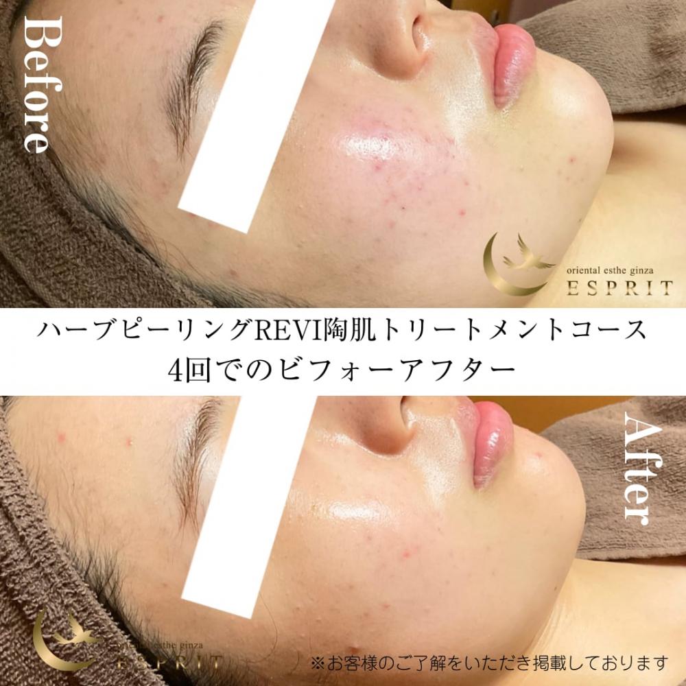 もう夏の肌荒れで悩まない!ピーリングで夏の肌トラブル解消!事例紹介