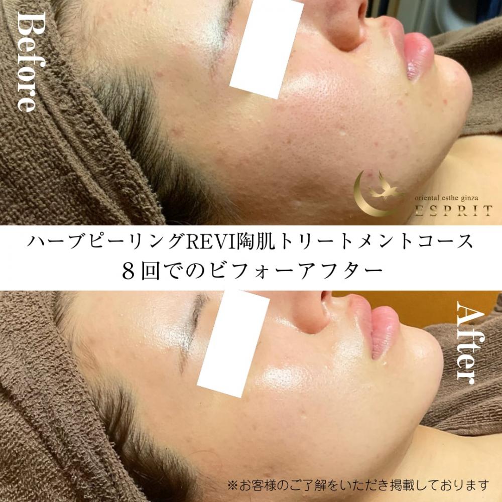 もう夏の肌荒れで悩まない!ピーリングで夏の肌トラブル解消!事例紹介