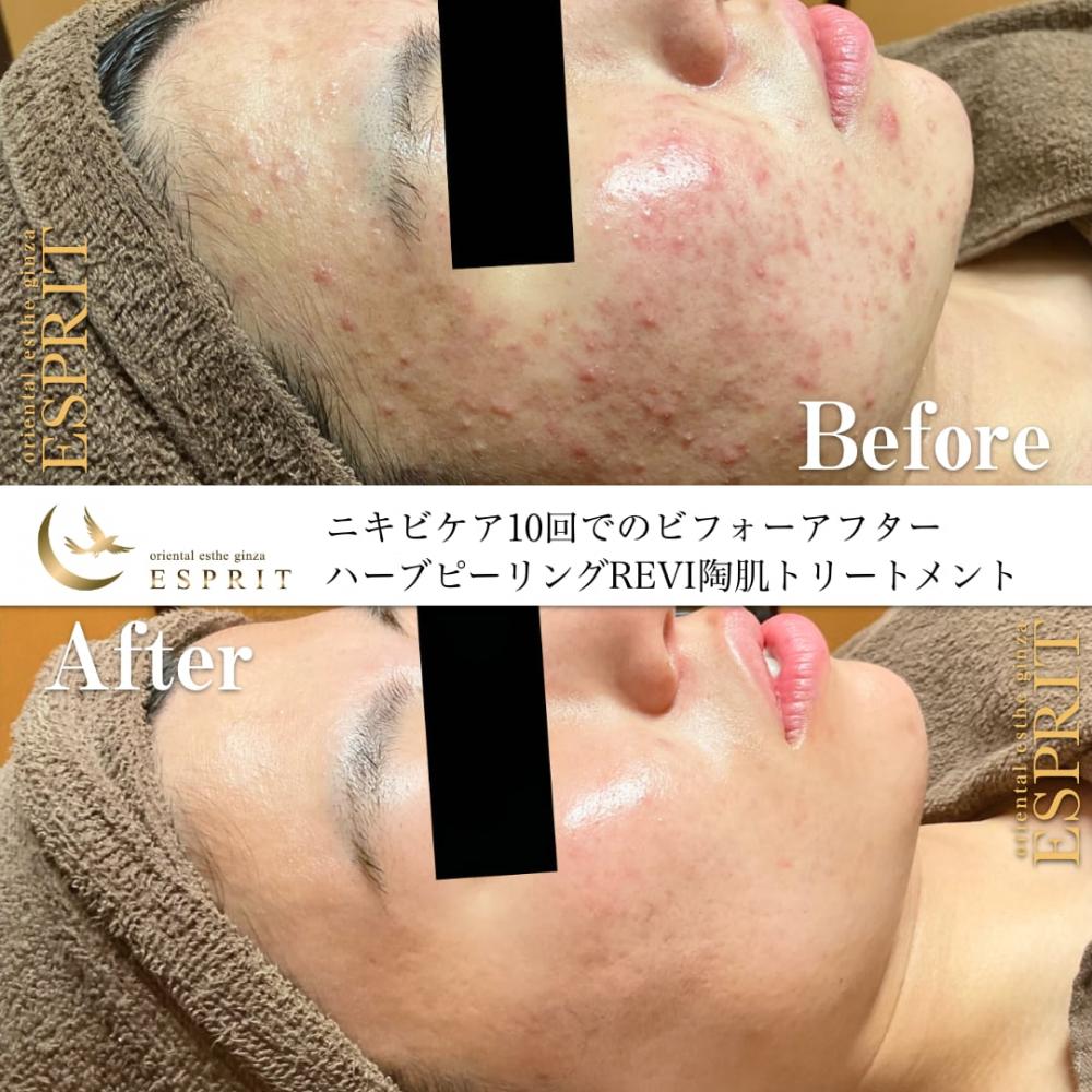 もう夏の肌荒れで悩まない!ピーリングで夏の肌トラブル解消!事例紹介