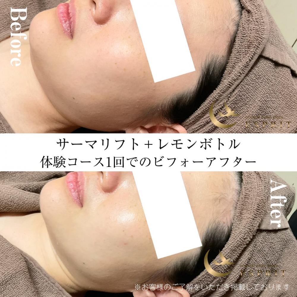 最新高周波サーマリフト+レモンボトル
