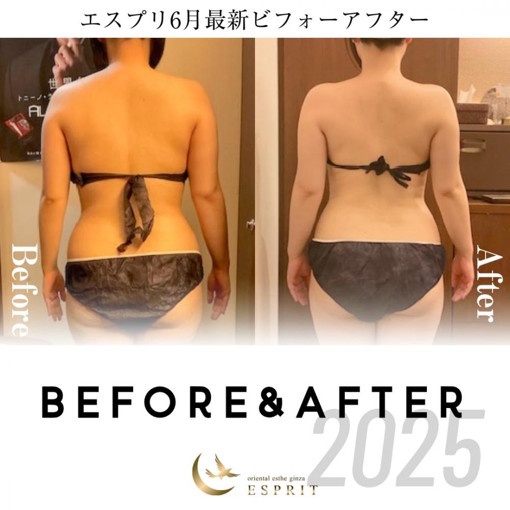 【2025年6月の痩身&肌改善エステ】ビフォーアフター