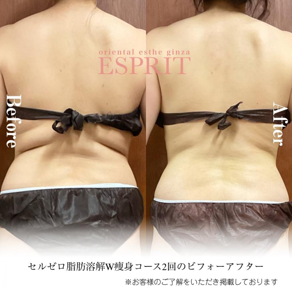 2024年6月痩身&肌改善(肌管理)エステコースのビフォーアフターをご紹介!