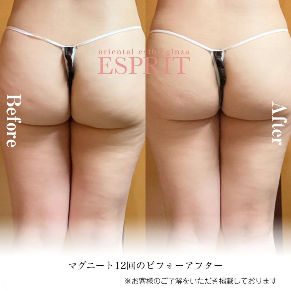 2024年6月痩身&肌改善(肌管理)エステコースのビフォーアフターをご紹介!