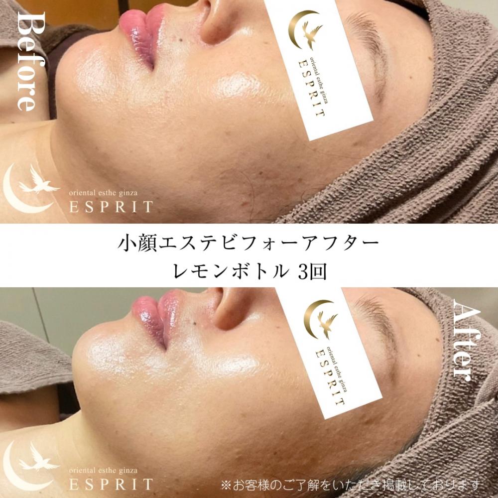 レモンボトル小顔エステのビフォーアフターを大公開！