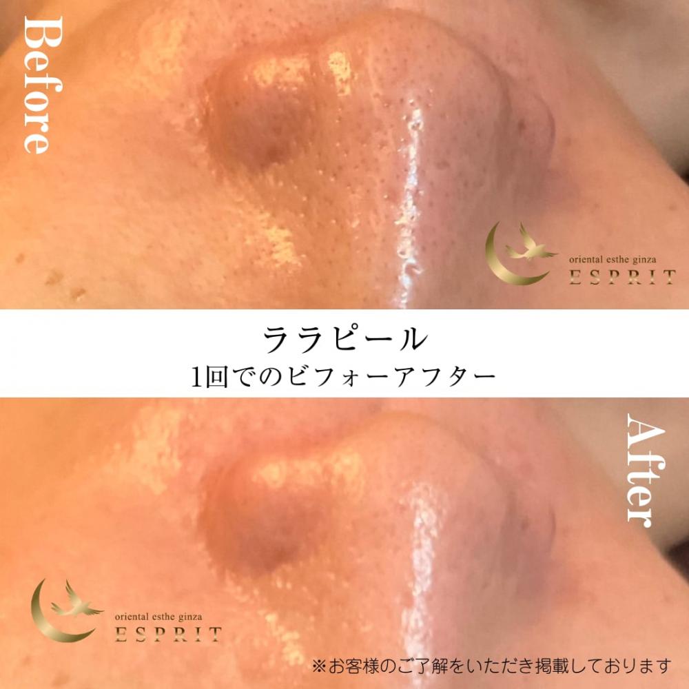 夏こそ試したい!銀座・新宿でできる透明感&ハリ肌を育てる新感覚ピーリング「ララピール」