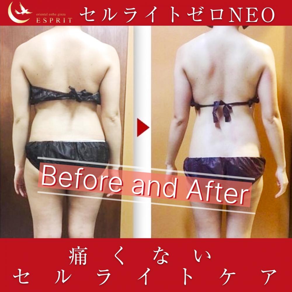 時短痩身&痛くないセルライトケア!セルライトゼロのビフォーアフター!