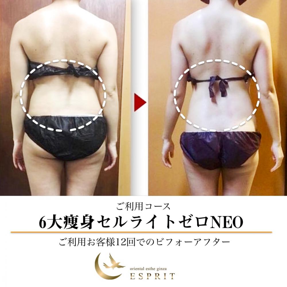 時短痩身&痛くないセルライトケア!セルライトゼロのビフォーアフター!