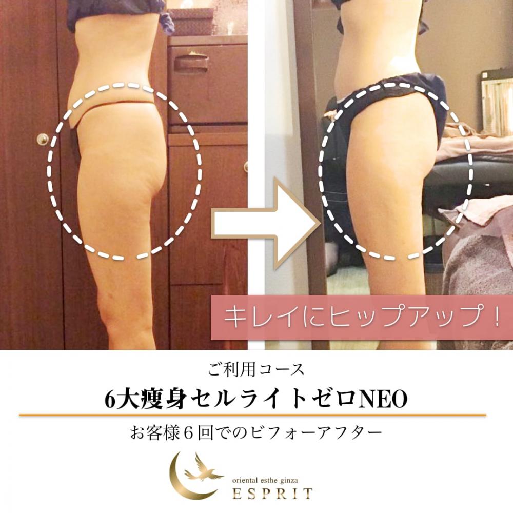時短痩身&痛くないセルライトケア!セルライトゼロのビフォーアフター!